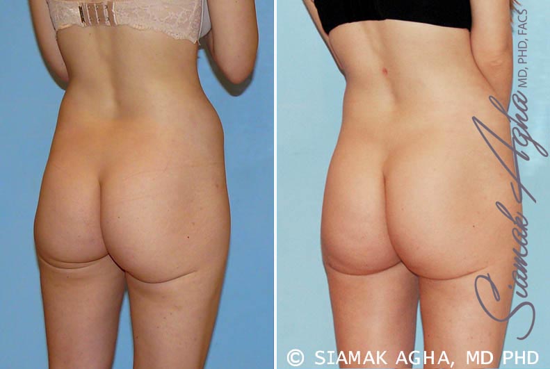 orange county brazilian butt lift patient 11 back right Newport Beach, CA