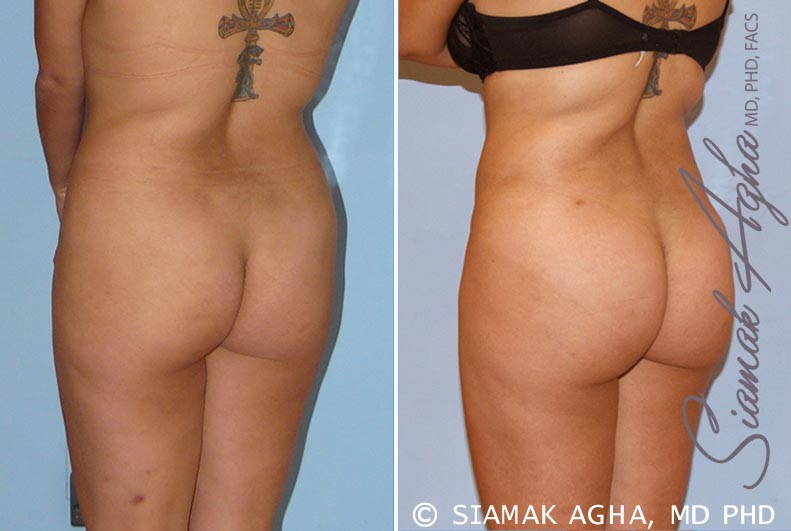 orange county brazilian butt lift patient 13 back left Newport Beach, CA