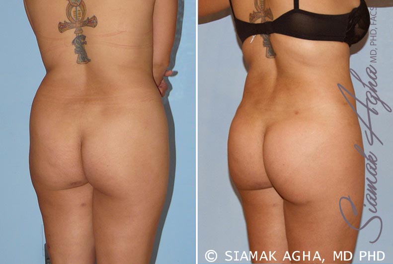 orange county brazilian butt lift patient 13 back right Newport Beach, CA