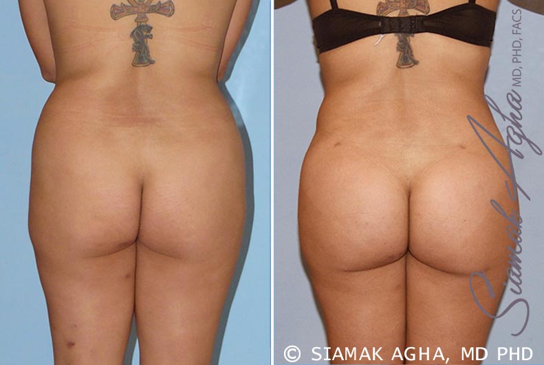 orange county brazilian butt lift patient 13 back Newport Beach, CA