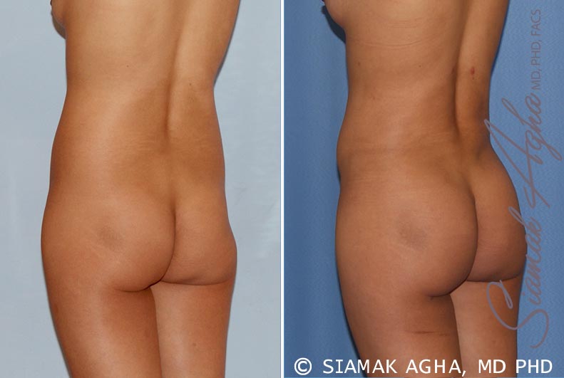 orange county brazilian butt lift patient 16 back left Newport Beach, CA