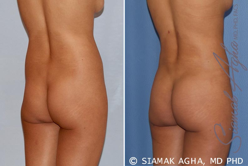 orange county brazilian butt lift patient 16 back right Newport Beach, CA