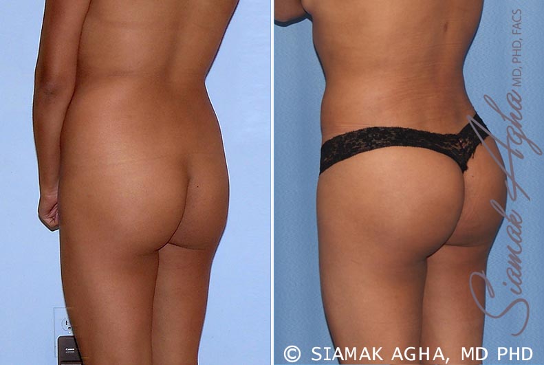 orange county brazilian butt lift patient 19 back left Newport Beach, CA