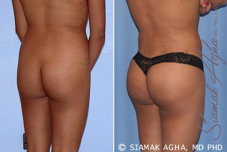 orange county brazilian butt lift patient 19 back right Newport Beach, CA