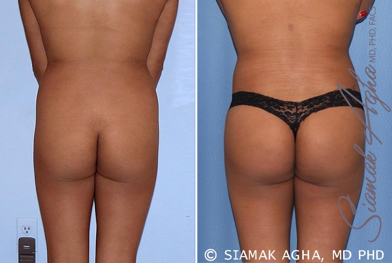 orange county brazilian butt lift patient 19 back Newport Beach, CA