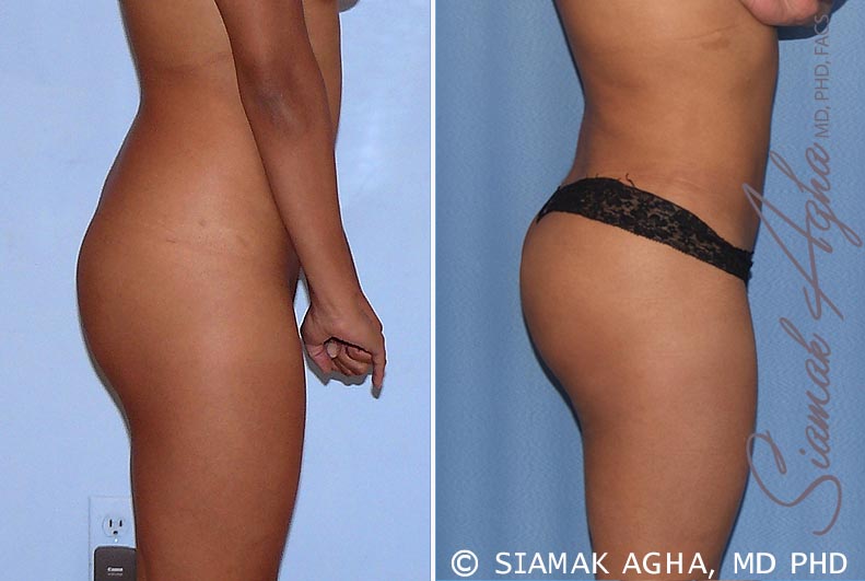 orange county brazilian butt lift patient 19 right Newport Beach, CA