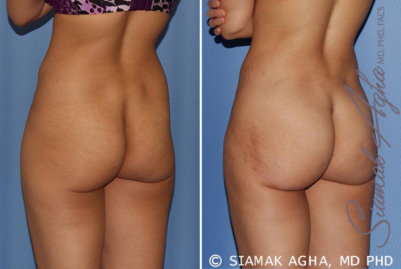 orange county brazilian butt lift patient 20 back left Newport Beach, CA