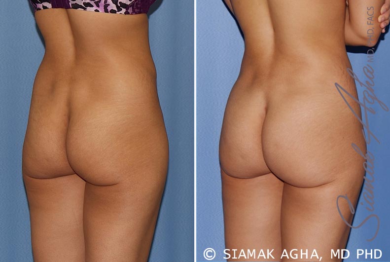 orange county brazilian butt lift patient 20 back right Newport Beach, CA