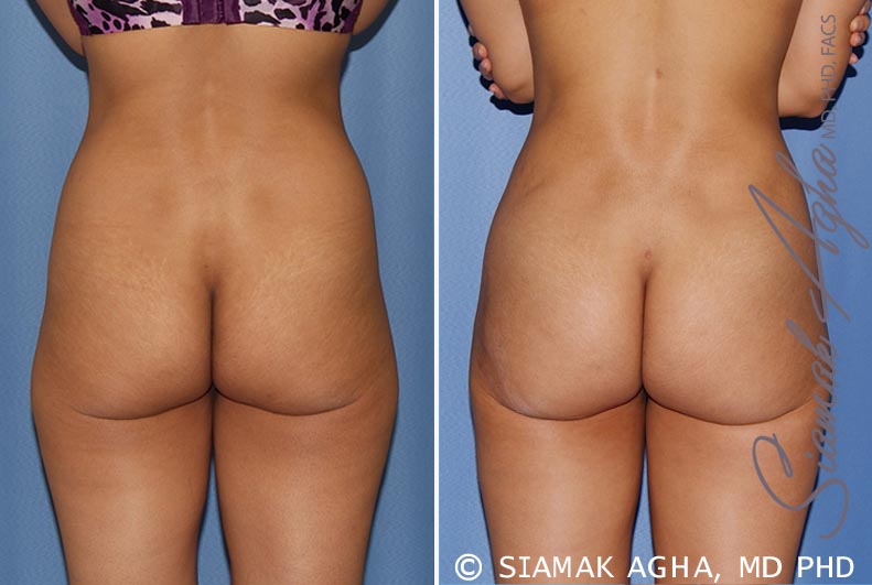 orange county brazilian butt lift patient 20 back Newport Beach, CA