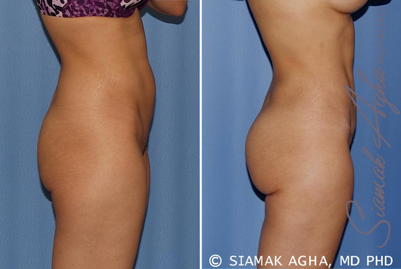 orange county brazilian butt lift patient 20 right Newport Beach, CA