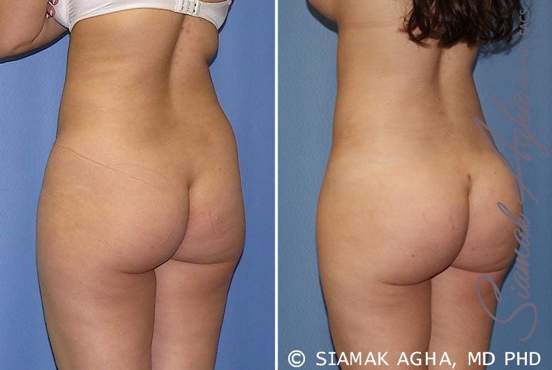 orange county brazilian butt lift patient 21 back left Newport Beach, CA