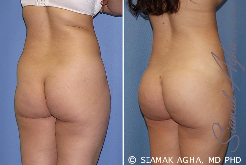 orange county brazilian butt lift patient 21 back right Newport Beach, CA