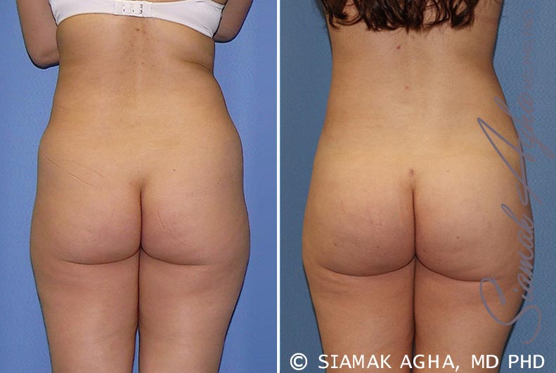 orange county brazilian butt lift patient 21 back Newport Beach, CA