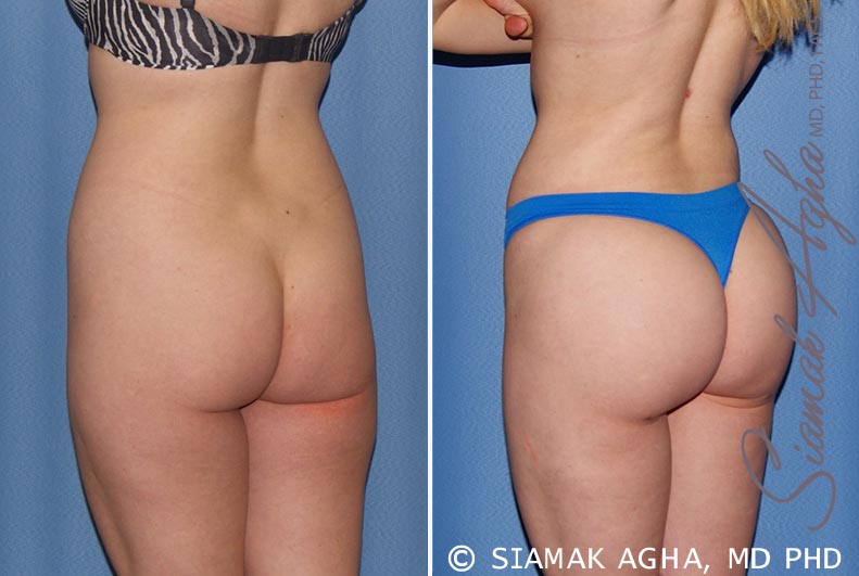 orange county brazilian butt lift patient 22 back left Newport Beach, CA