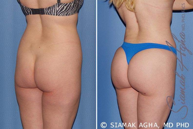 orange county brazilian butt lift patient 22 back right Newport Beach, CA