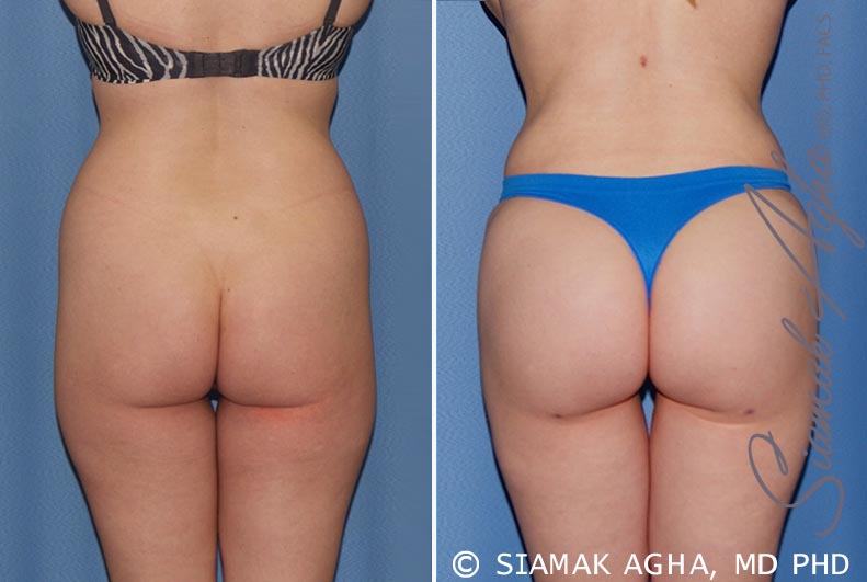 orange county brazilian butt lift patient 22 back Newport Beach, CA