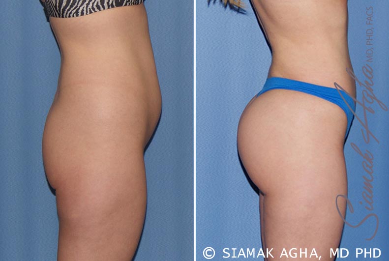 orange county brazilian butt lift patient 22 right Newport Beach, CA