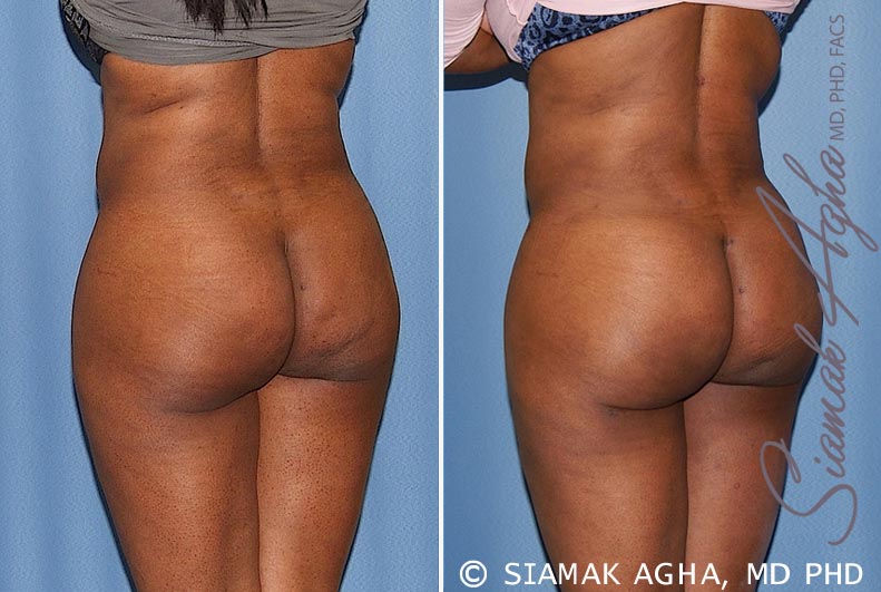 orange county brazilian butt lift patient 23 back left Newport Beach, CA