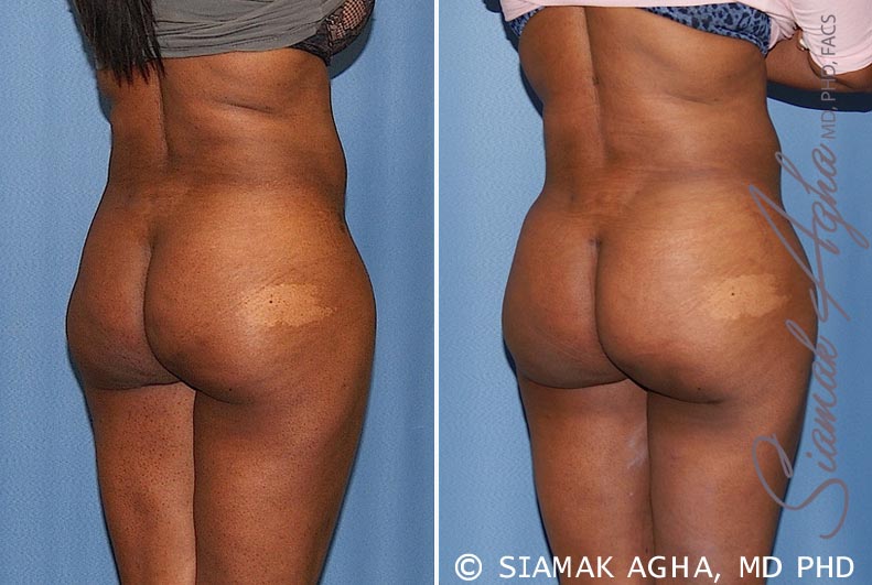 orange county brazilian butt lift patient 23 back right Newport Beach, CA