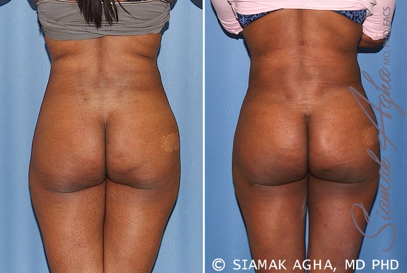 orange county brazilian butt lift patient 23 back Newport Beach, CA