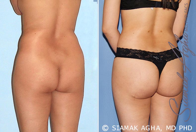 orange county brazilian butt lift patient 24 back left Newport Beach, CA