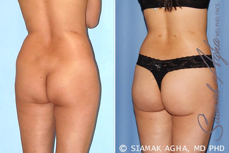 orange county brazilian butt lift patient 24 back right Newport Beach, CA