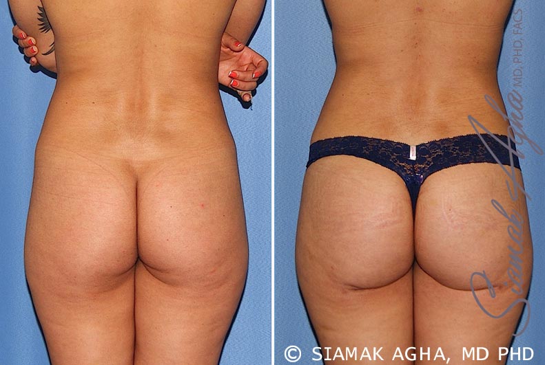 orange county brazilian butt lift patient 25 back 1 Newport Beach, CA