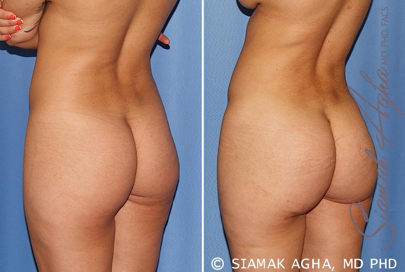 orange county brazilian butt lift patient 25 back left Newport Beach, CA