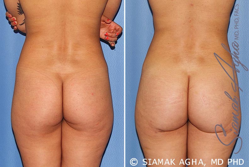 orange county brazilian butt lift patient 25 back Newport Beach, CA