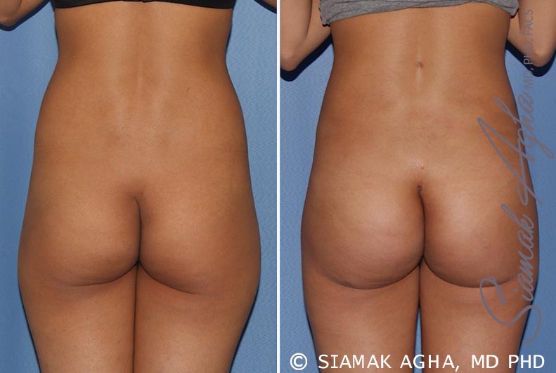 Orange County Brazilian Butt Lift Patient 26 Back Newport Beach, CA