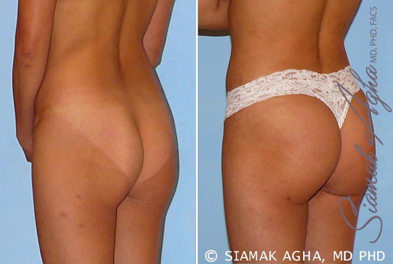 orange county brazilian butt lift patient 27 back left Newport Beach, CA