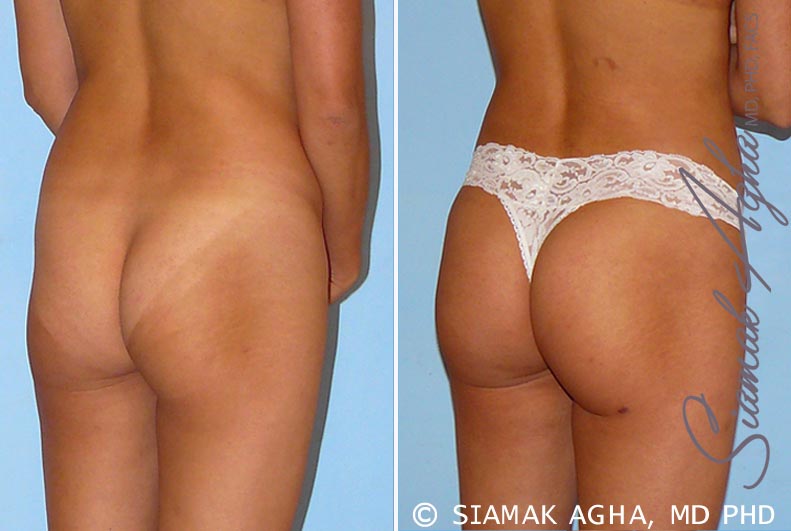 Orange County Brazilian Butt Lift Patient 27 Back Right Newport Beach, CA