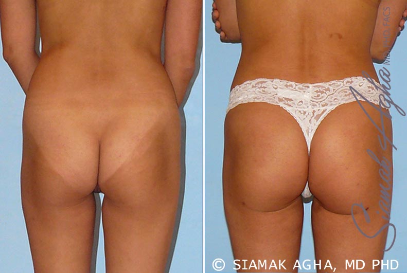 Orange County Brazilian Butt Lift Patient 27 Back Newport Beach, CA