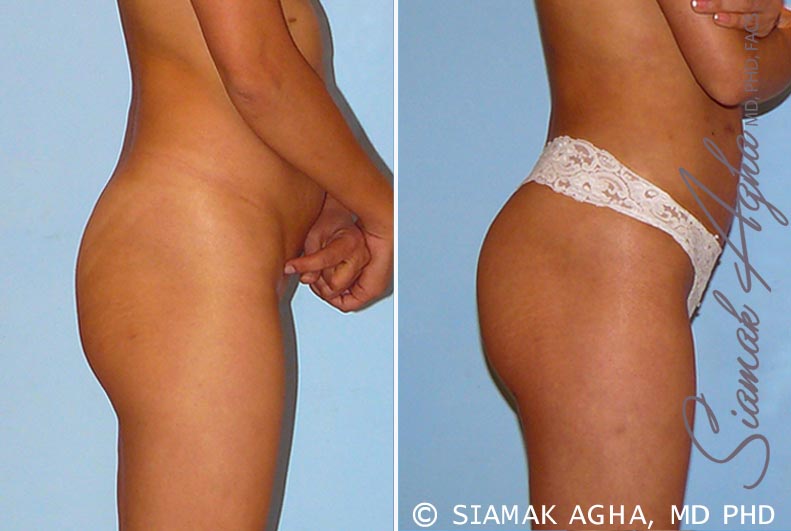 orange county brazilian butt lift patient 27 right Newport Beach, CA