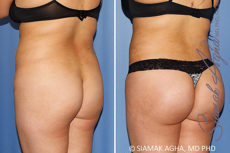 orange county brazilian butt lift patient 28 back left Newport Beach, CA