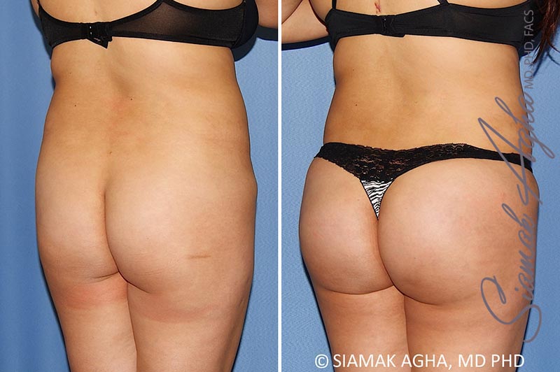 Orange County Brazilian Butt Lift Patient 28 Back Right Newport Beach, CA