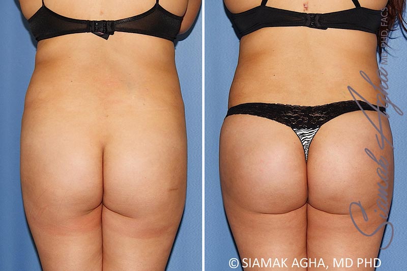 orange county brazilian butt lift patient 28 back Newport Beach, CA