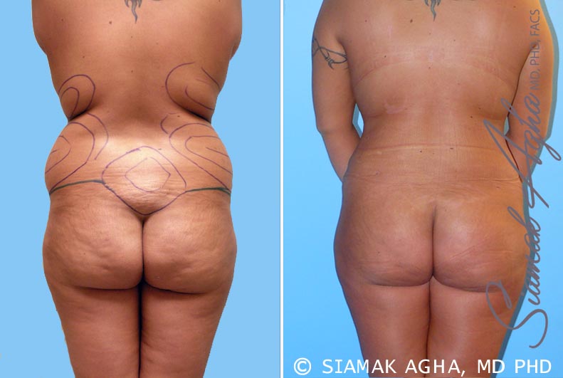 orange county brazilian butt lift patient 3 back Newport Beach, CA