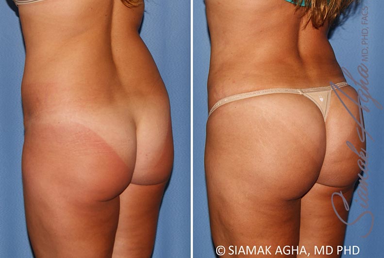 Orange County Brazilian Butt Lift Patient 30 Back Left Newport Beach, CA