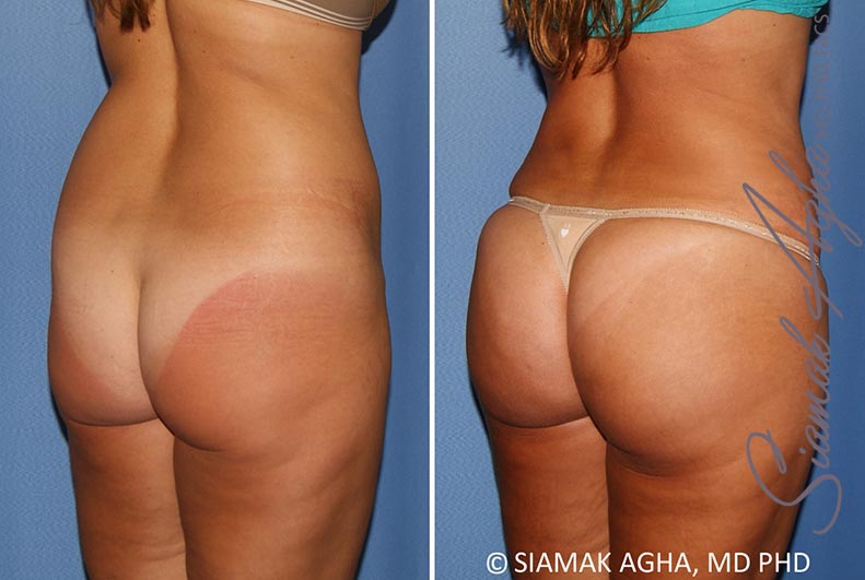 Orange County Brazilian Butt Lift Patient 30 Back Right Newport Beach, CA