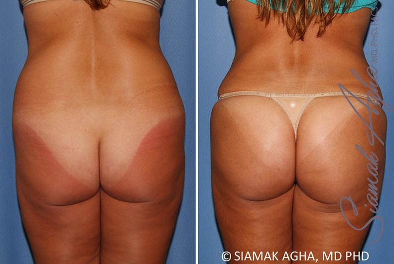 Orange County Brazilian Butt Lift Patient 30 Back Newport Beach, CA