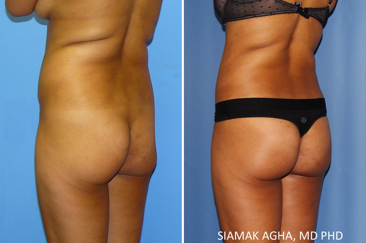 orange county brazilian butt lift patient 31 back left Newport Beach, CA