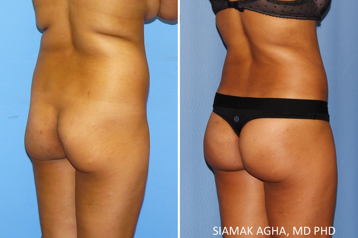 orange county brazilian butt lift patient 31 back right Newport Beach, CA