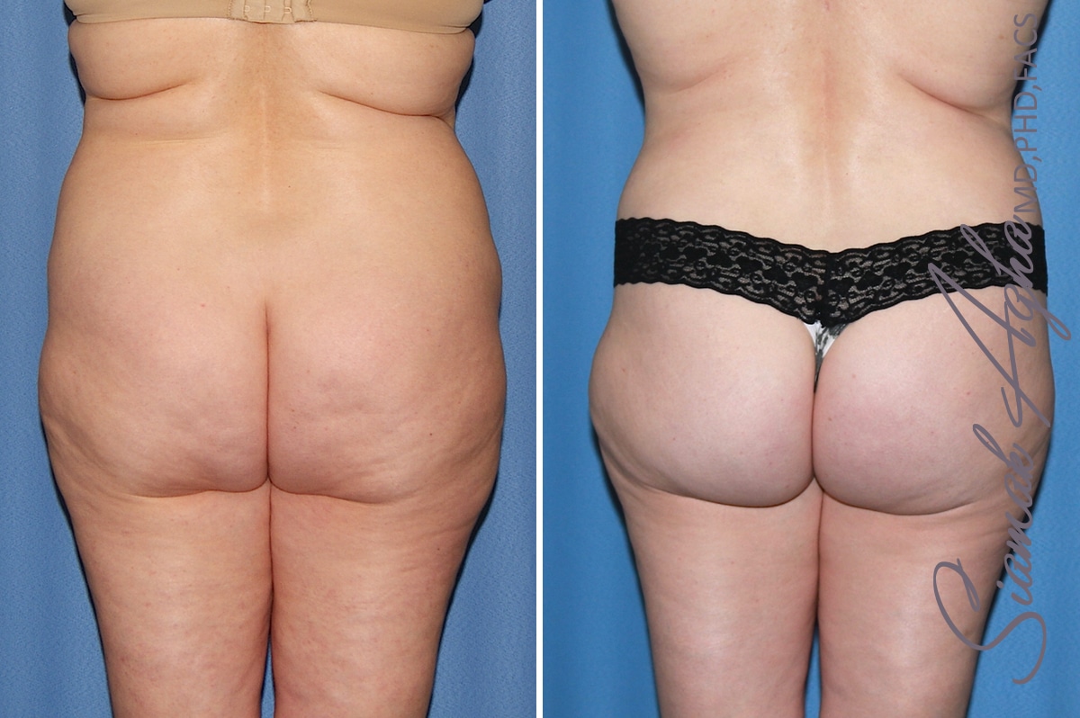 orange county brazilian butt lift patient 32 back 1 Newport Beach, CA