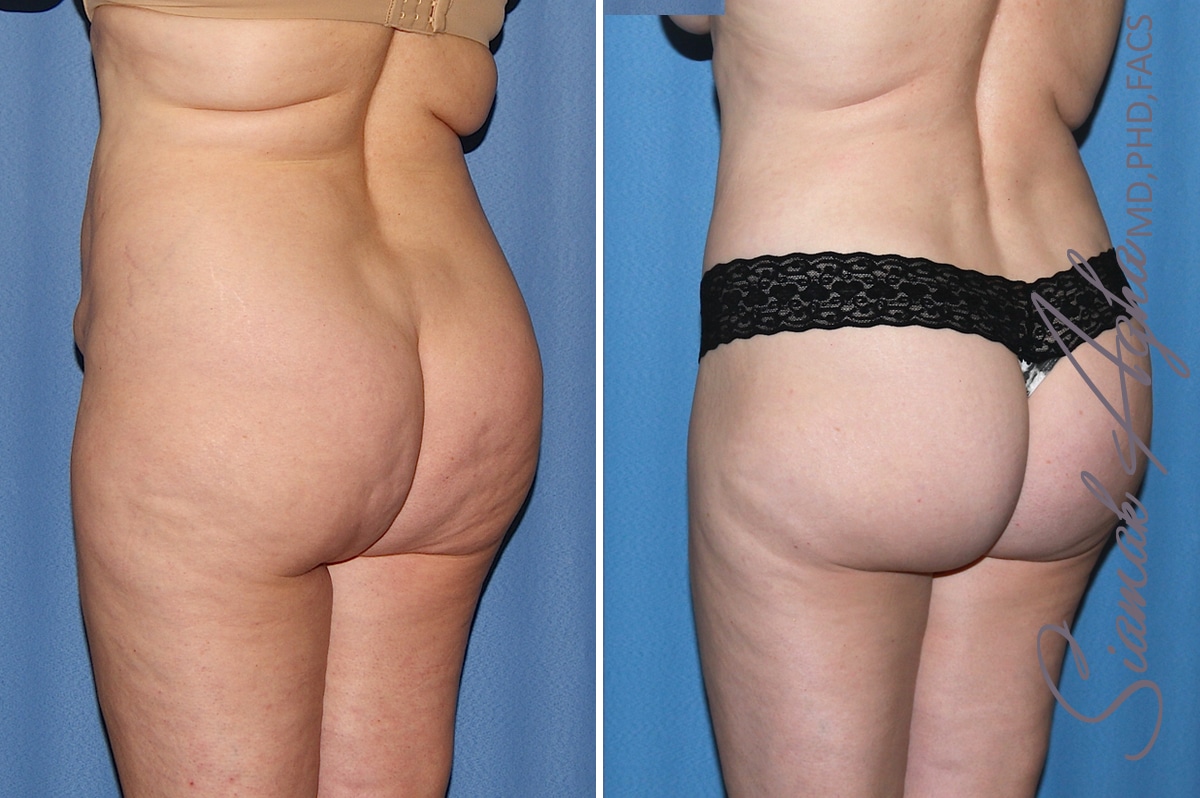 orange county brazilian butt lift patient 32 back left 2 Newport Beach, CA