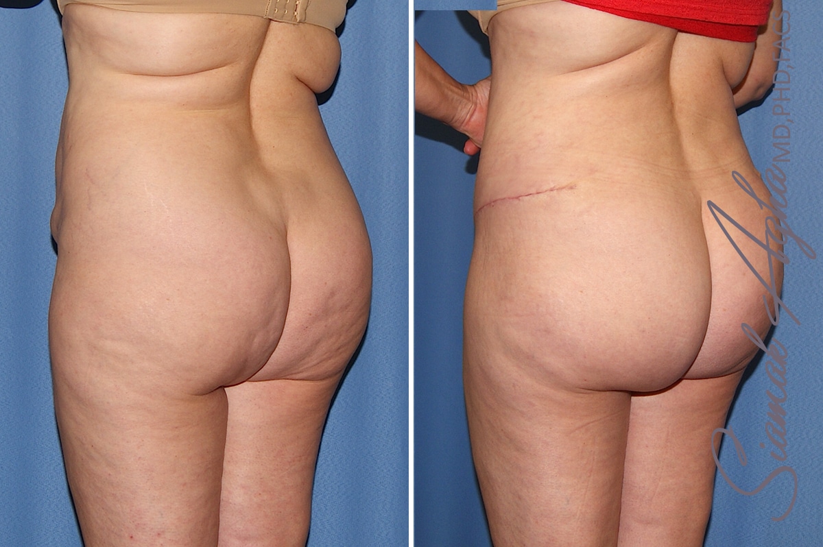 orange county brazilian butt lift patient 32 back left Newport Beach, CA