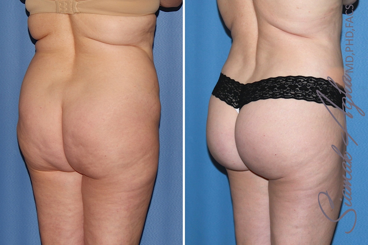 Orange County Brazilian Butt Lift Patient 32 Back Right 2 Newport Beach, CA