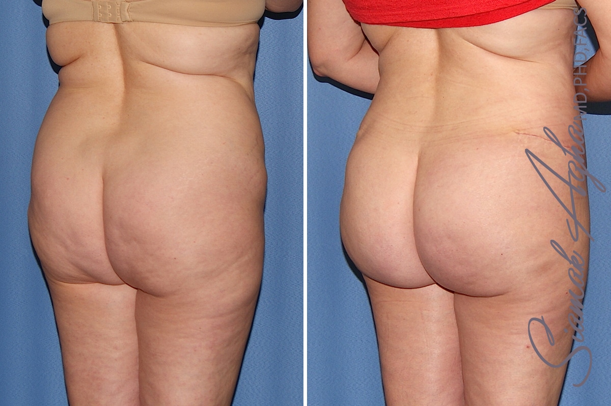 orange county brazilian butt lift patient 32 back right Newport Beach, CA