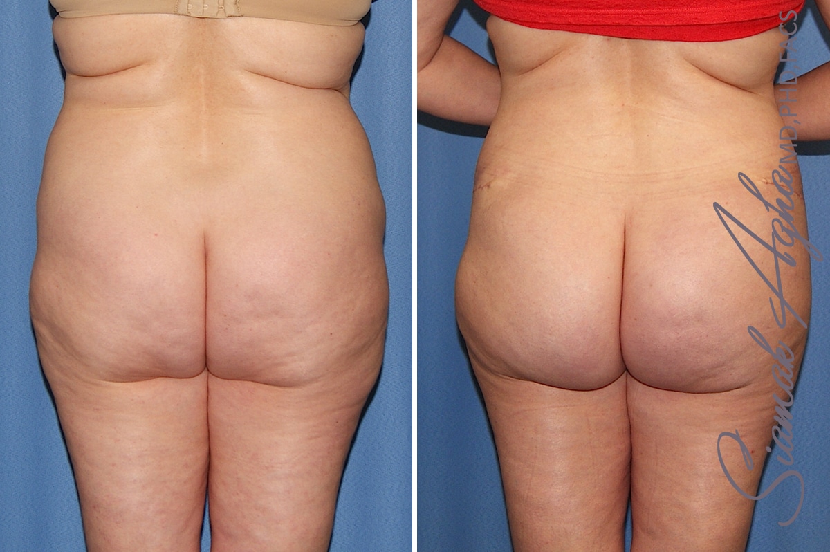 orange county brazilian butt lift patient 32 back Newport Beach, CA