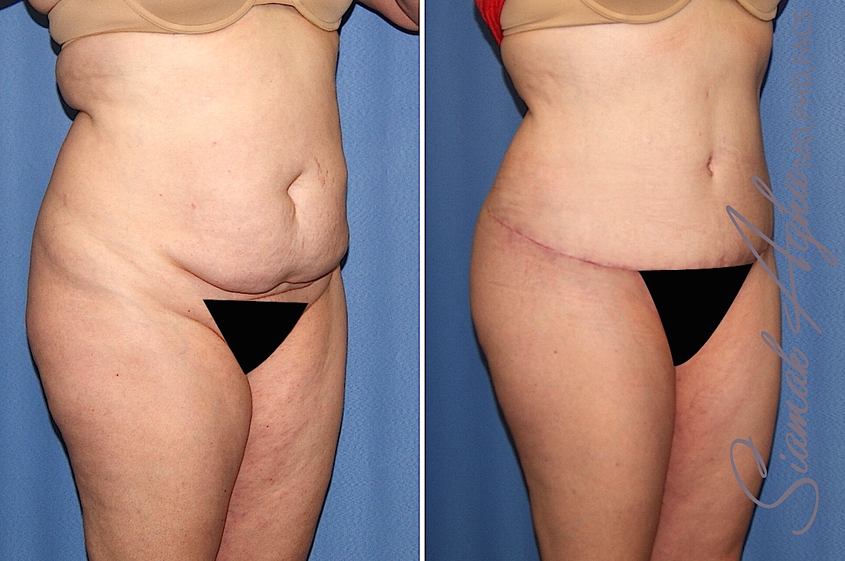 Orange County Brazilian Butt Lift Patient 32 Front Right Newport Beach, CA